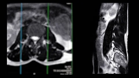 MRI L-S spine . Stock Footage 201429358