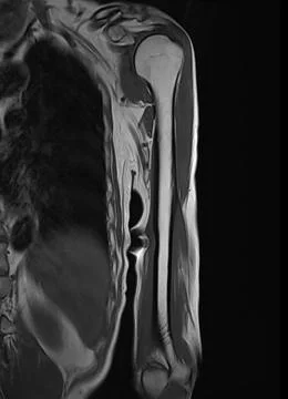 MRI Left humerus bone for diagnosis bone tumor. 스톡 일러스트