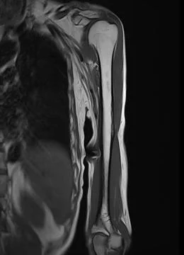 MRI Left humerus bone for diagnosis bone tumor. Stock Illustration