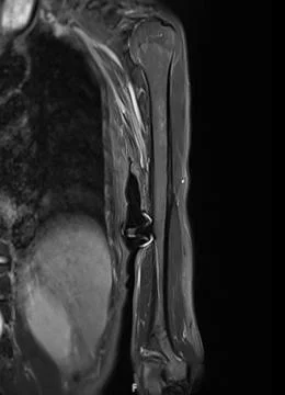MRI Left humerus bone for diagnosis bone tumor. Stock Illustration