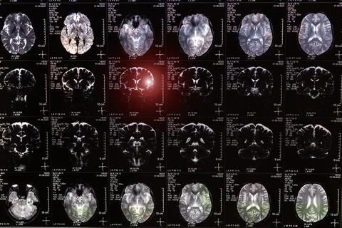 MRI, MRT, CT scan image of human brain. Medical treatmant concept. Stock Photos