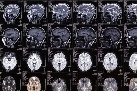 MRI, MRT, CT scan image of human brain. Medical treatmant concept. Diagnosi.. Stock Photos