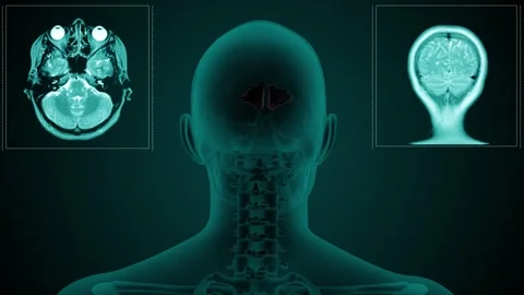 MRI paranasal sinus Frontal Video stock 276228324