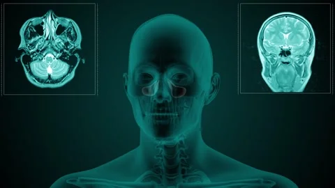 MRI paranasal sinus Maxillar Video stock 275845673