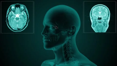 MRI paranasal sinus Sphenoid Stock Footage 275648762