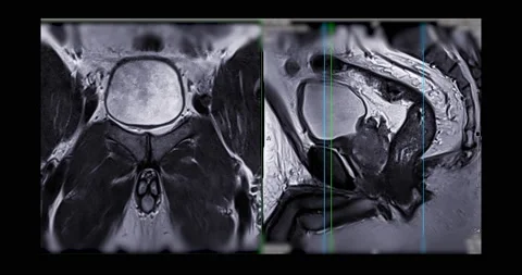 MRI prostate gland Stock Footage 196180770