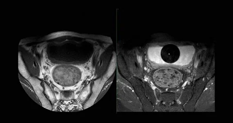 MRI prostate gland . Stock Footage 222929547