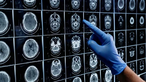 MRI scan analysis  Stock Footage 196156341