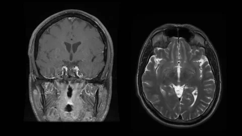 MRI scan of Brain and head from a forty year old male with an acoustic neuroma 스톡 동영상 150936616