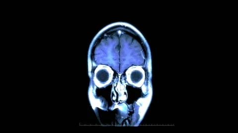 MRI Scan of the Brain - Back to Front 库存影片 44556871