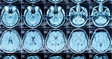 MRI scan of the brain close up, looped Stock Footage 106322116
