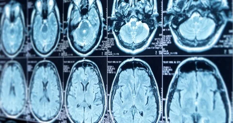 MRI scan of the brain close up scroll up, looped Stock Footage 106322129
