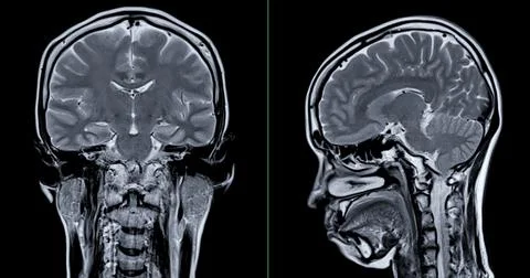 MRI scan of the  brain   for detect  Brain  diseases sush as stroke disease.. Stock Photos