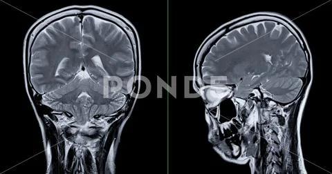 Mri Scan Of The Brain For Detect Brain Diseases Sush As Stroke Disease 