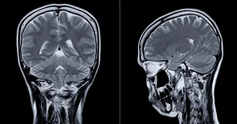 MRI scan of the  brain   for detect  Brain  diseases sush as stroke disease.. Stock Photos
