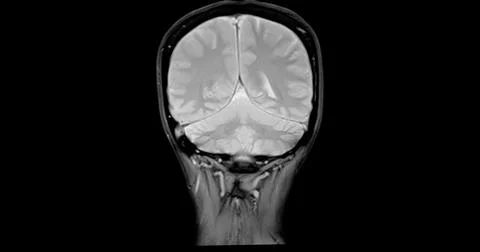 MRI scan of the  brain   for detect  Brain  diseases sush as stroke disease.. Stock Photos