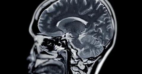 MRI scan of the  brain   for detect  Brain  diseases sush as stroke disease.. Stock Photos
