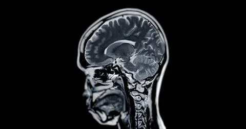 MRI scan of the  brain   for detect  Brain  diseases sush as stroke disease.. Stock Photos