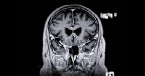 MRI scan of the  brain   for detect  Brain  diseases sush as stroke disease.. Stock Photos