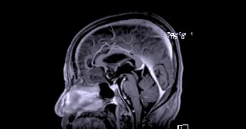 MRI scan of the  brain   for detect  Brain  diseases sush as stroke disease.. Stock Photos