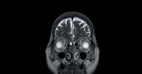 MRI scan of the  brain   for detect  Brain  diseases sush as stroke disease.. Stock Photos