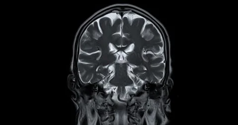MRI scan of the  brain   for detect  Brain  diseases sush as stroke disease.. Stock Photos