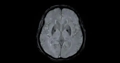 MRI scan of the  brain   for detect  Brain  diseases sush as stroke disease.. Stock Photos