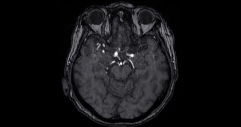 MRI scan of the  brain   for detect  Brain  diseases sush as stroke disease.. Stock Photos