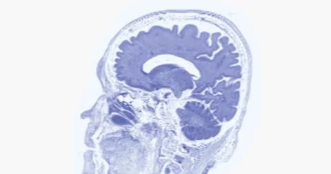 MRI scan of the  brain   for detect  Brain  diseases sush as stroke disease.. Stock Photos