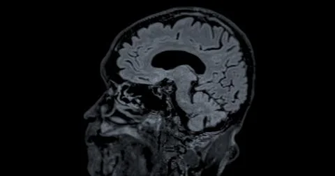 MRI scan of the  brain   for detect  Brain  diseases sush as stroke disease.. Stock Photos
