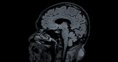 MRI scan of the  brain   for detect  Brain  diseases sush as stroke disease.. Stock Photos