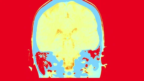 MRI Scan of the Brain Highlighting Enhanced Structural Features with Color-Coded Stock Footage 318634969