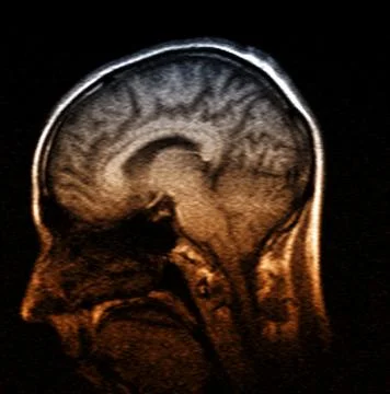 MRI Scan of Brain Stock Photos