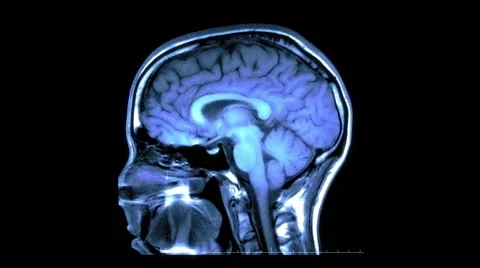 MRI Scan of the Brain - Side to Side 库存影片 44557147