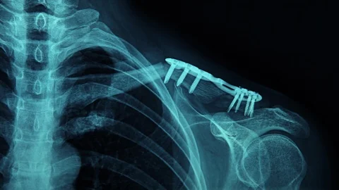 MRI Scan Broken Collar Bone Stock Footage 87142704