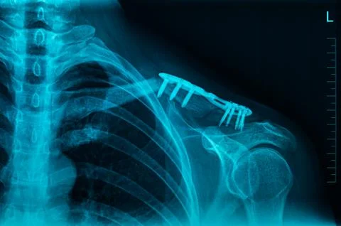 MRI Scan Broken Collar Bone Foto stock