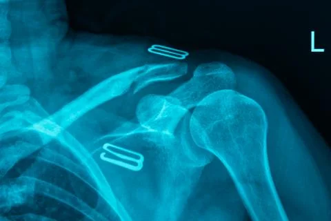 MRI Scan Broken Collar Bone Foto stock