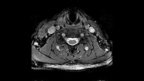 MRI scan of the cervical spine, detection of protrusions and hernias Stock Footage 113740569