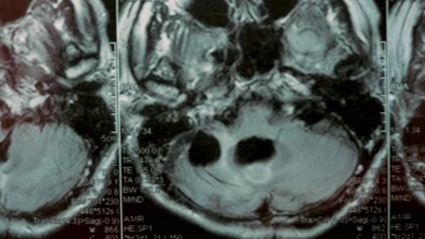 MRI scan of the head. First-person view. The picture shows a large cyst and bone Stock Footage 153691824