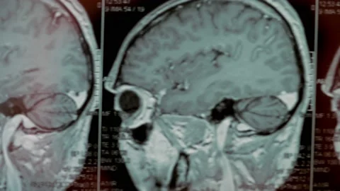 MRI scan of the head. First-person view. The picture shows a large cyst and bone Stock Footage 153692032
