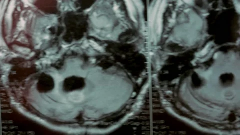 MRI scan of the head. First-person view. The picture shows a large cyst and bone Stock Footage 153692227