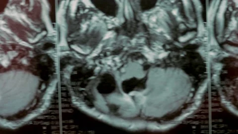 MRI scan of the head. First-person view. The picture shows a large cyst and bone Stock Footage 153692606