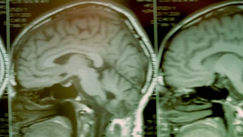 MRI scan of the head. First-person view. The picture shows a large cyst and bone Stock-Footage 153692838