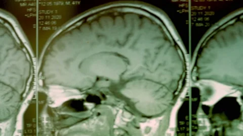 MRI scan of the head. First-person view. The picture shows a large cyst and bone Stock Footage 153693040
