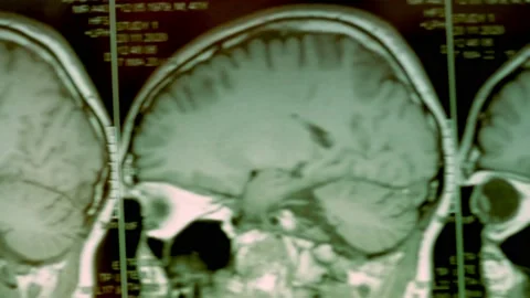 MRI scan of the head. First-person view. The picture shows a large cyst and bone Stock Footage 153693202