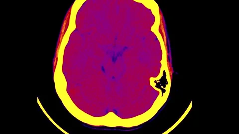 MRI Scan of the Human Brain: Analyzing Structural Features and Pathologies with Stock Footage 318506327