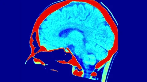 MRI Scan of the Human Brain with Color Mapping: Detailed Visualization of Brain Stock Footage 317528614