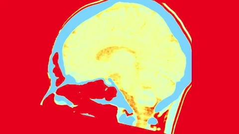 MRI Scan of the Human Brain Featuring Distinctive Color Patterns in a Transverse Stock Footage 318634958
