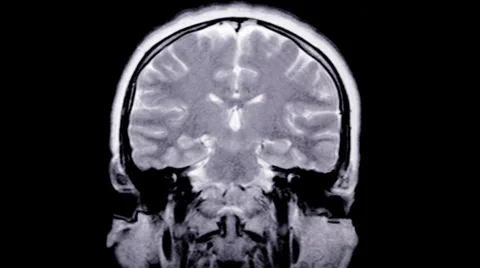 MRI scan. Human brain. Stock Footage 35787117