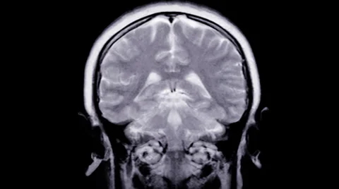 MRI scan. Human brain. 動画素材 35787543